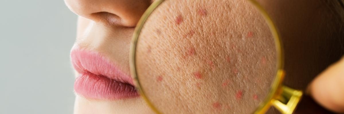 Acne gravídica: entenda causas, efeitos e como lidar durante a gravidez